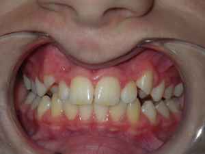 Teeth after Invisalign